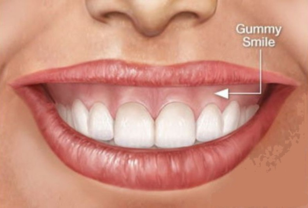 Botulotoxín / Gummy Smile - Over Smile