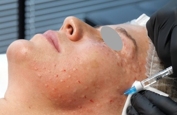 Ako prebieha procedúra