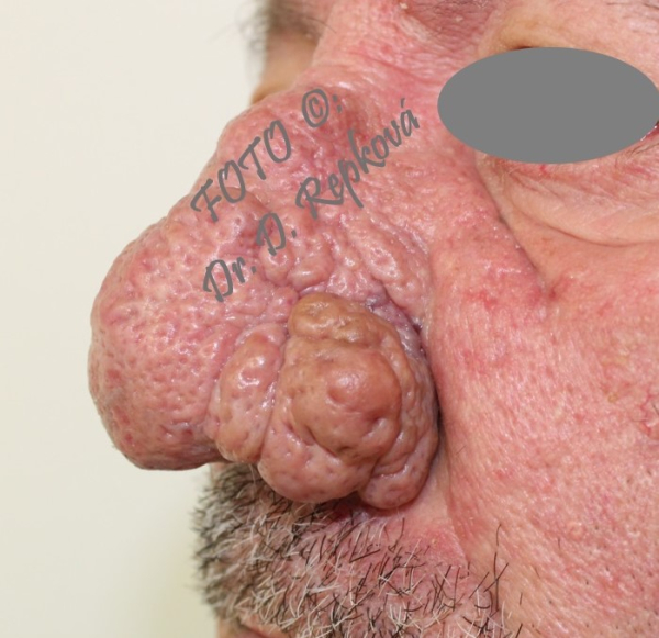 Rhinophyma